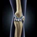 Replacement knee illustration