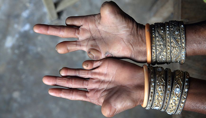 Hands (affected by leprosy) with misshapen fingers.