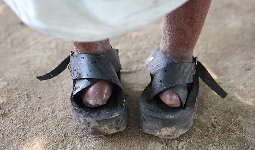 Feet affected by leprosy and covered with protective shoes.